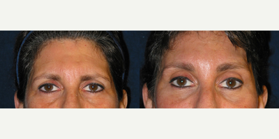 Brow Lift before and after photo