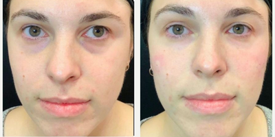 Dermal Fillers before and after photo