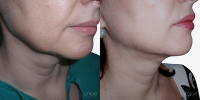Nonsurgical Facelift before and after photo