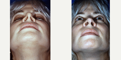 Revision Rhinoplasty before and after photo
