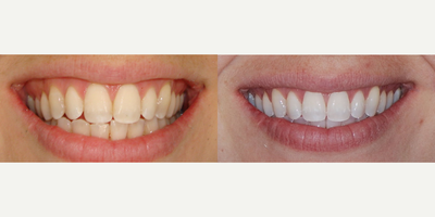 Teeth Whitening before and after photo