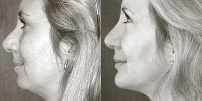 Rhinoplasty before and after photo