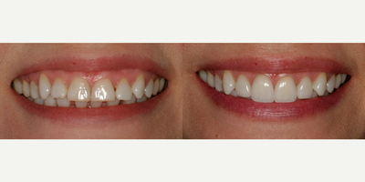 Smile Makeover before and after photo