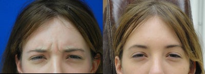 Botox before and after photo