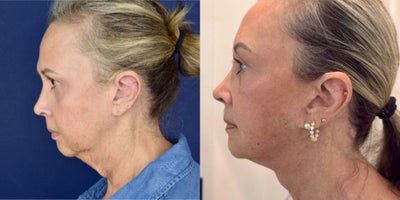 Deep Plane Facelift before and after photo