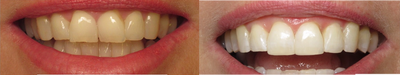 Dental Bonding before and after photo