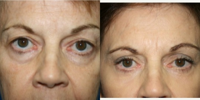 Eyelid Surgery before and after photo