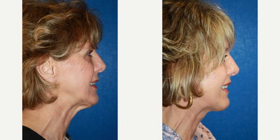 Facelift before and after photo