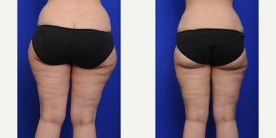 Liposuction before and after photo