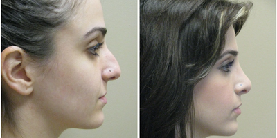 Rhinoplasty before and after photo