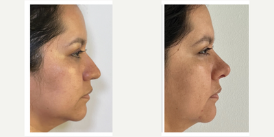 Rhinoplasty before and after photo