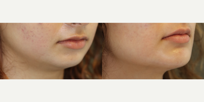 Chin Implant before and after photo