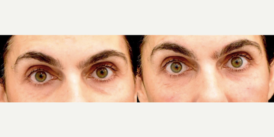 Dermal Fillers before and after photo