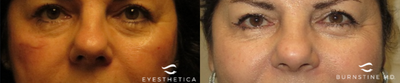 Juvederm before and after photo