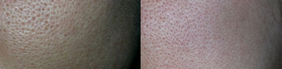 Laser Resurfacing before and after photo
