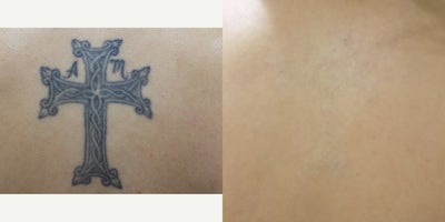 Tattoo Removal before and after photo