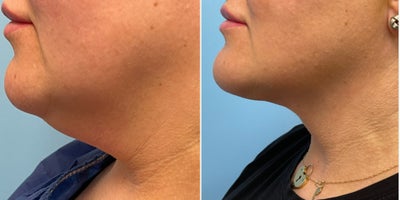 before and after image