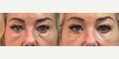 Eyelid Surgery before and after photo