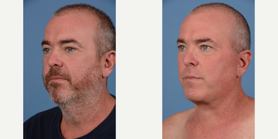 Facelift before and after photo