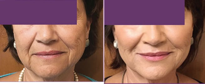 Liquid Facelift before and after photo