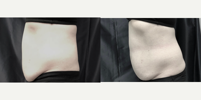 SculpSure before and after photo