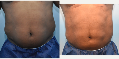 Smart Lipo before and after photo