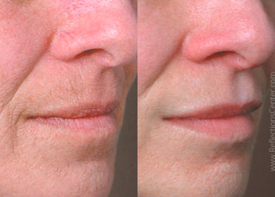 Volbella before and after photo
