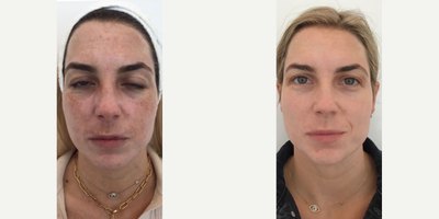 Chemical Peel before and after photo