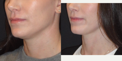 Kybella before and after photo