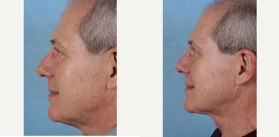 Neck Lift before and after photo