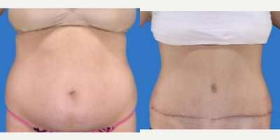 Tummy Tuck before and after photo