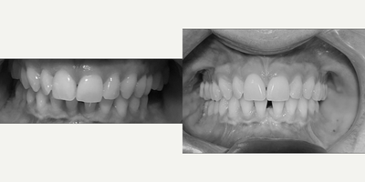 Braces before and after photo