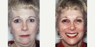 Facelift before and after photo