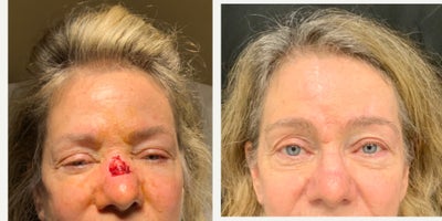 Mohs Surgery before and after photo