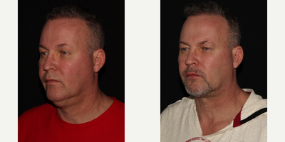 Neck Lift before and after photo