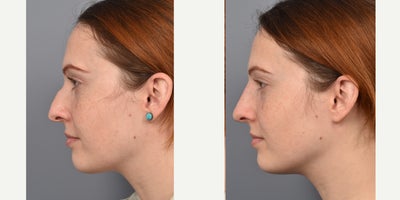 Nonsurgical Nose Job before and after photo