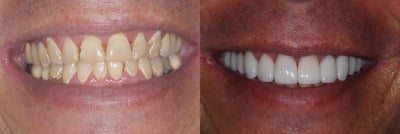 Porcelain Veneers before and after photo