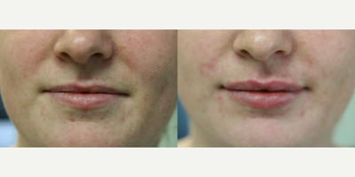 Restylane Silk before and after photo