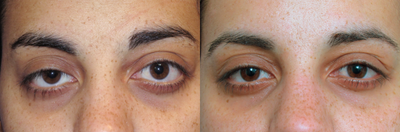 Botox before and after photo