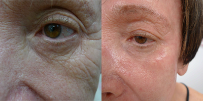 Eyelid Surgery before and after photo