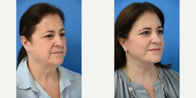Facelift before and after photo
