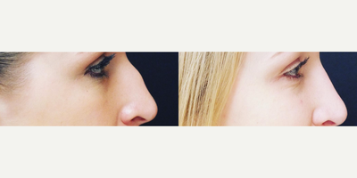 Rhinoplasty before and after photo