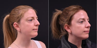 Rhinoplasty before and after photo