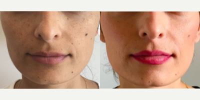 Sculptra before and after photo