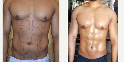 Abdominal Etching before and after photo