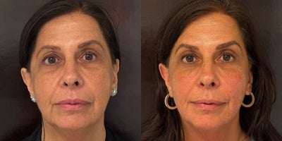 Botox before and after photo
