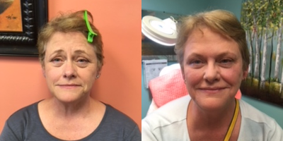 Dermal Fillers before and after photo