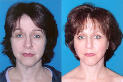 Facelift before and after photo