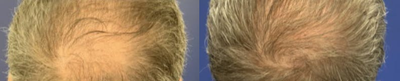 Hair Loss Treatment before and after photo