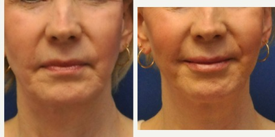 Juvederm before and after photo